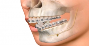 Maxilofacial