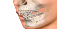 Maxilofacial